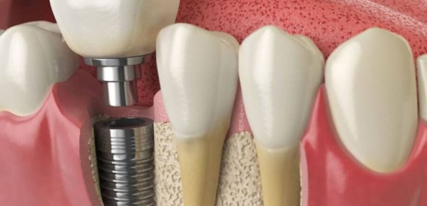 Dental Implant Failure Prevention?