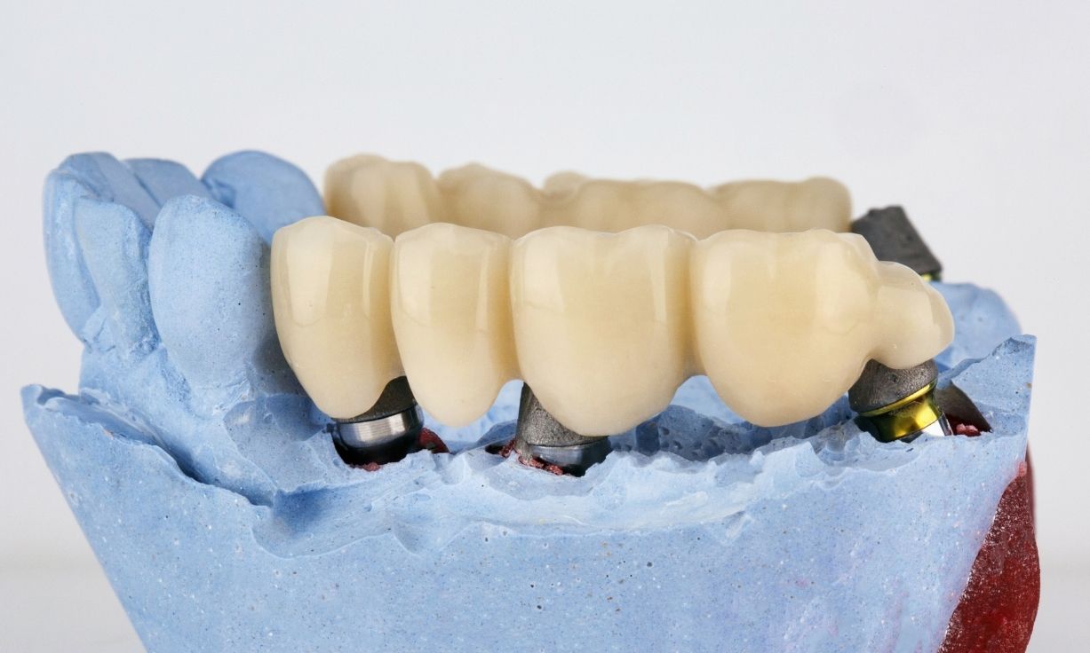 Dental Bridges: Restore Your Smile and Replace Missing Teeth