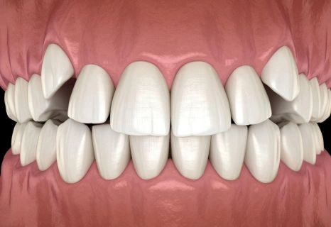 Crossbite dental malocclusion correction example at Aurora, IL dental practice showing misaligned teeth.