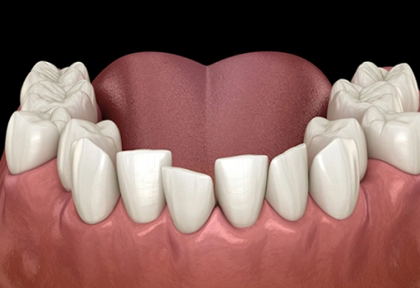 Dental crowding illustration showing misaligned upper teeth at Aurora, IL practice.