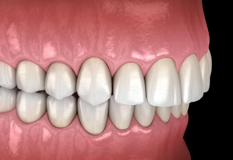 Overbite correction showing upper teeth overlapping lower teeth before orthodontic treatment in Aurora, IL.