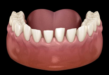 Dental spacing treatment illustration showing tooth gap closure at Aurora dental practice in Illinois.