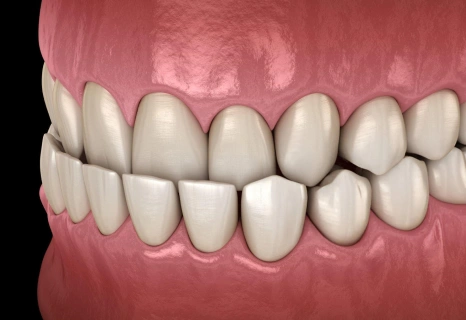 Underbite malocclusion correction with aligned teeth at dental office in Aurora, IL.