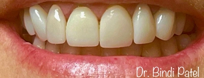 Patient smile after cosmetic dentistry at Dr. Bindi Patel dental office in Aurora, Illinois.