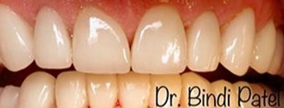 Cosmetic dental veneers before and after at Dr. Bindi Patel in Aurora, IL showing bright white smile results.