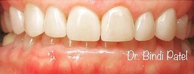 After cosmetic dental treatment at Aurora, IL dental office showing natural white teeth result.