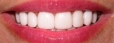 Patient smiling with bright white teeth after cosmetic dentistry at Aurora, IL dental office.