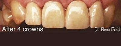 After 4 dental crowns at Aurora dental office in Aurora, IL showing natural tooth restoration.