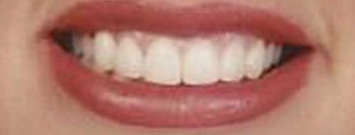 Patient smiling with white teeth after cosmetic dentistry at Aurora, IL dental office.