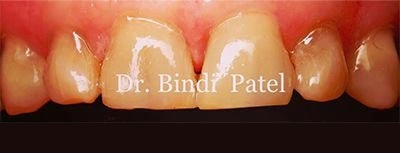 Before and after cosmetic dental treatment at Dr. Bindar Patel in Aurora, IL showing restored front teeth.