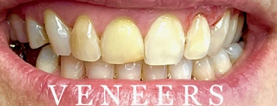 Dental veneers before and after at Aurora, IL dental office showing smile transformation.