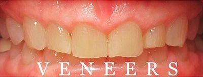 Dental veneers before and after result at Aurora, IL showing natural white teeth.
