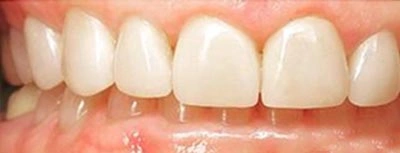 Before and after cosmetic dental treatment showing natural white teeth at Aurora, IL dental office.