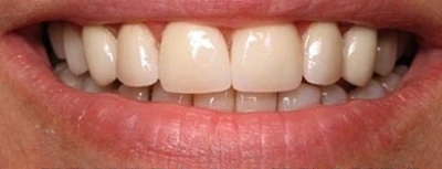 Before and after smile transformation with cosmetic dentistry at Aurora, IL dental practice showing natural white teeth.