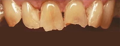 Before and after cosmetic dentistry results showing tooth whitening at dental practice in Aurora, IL.