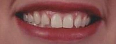 Before and after smile results from cosmetic dentistry at Aurora, IL dental office.