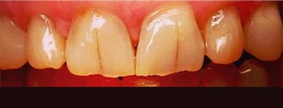 Before and after teeth whitening results at Prairie Street Dental in Aurora, IL.