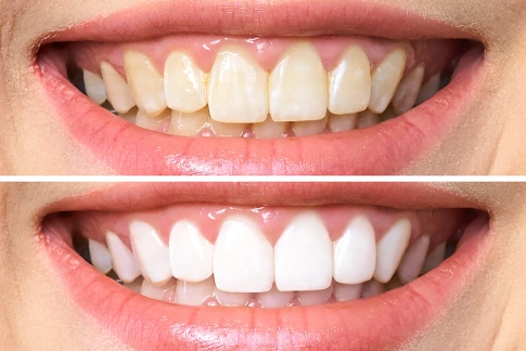 Before and after teeth whitening results at Aurora, Illinois dental practice showing brightened smile.