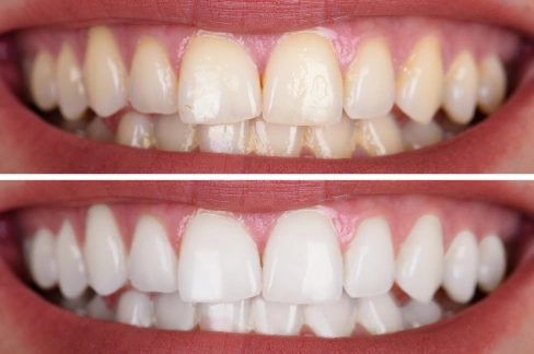 Teeth whitening before and after results at dental practice in Aurora, IL showing whiter smile.