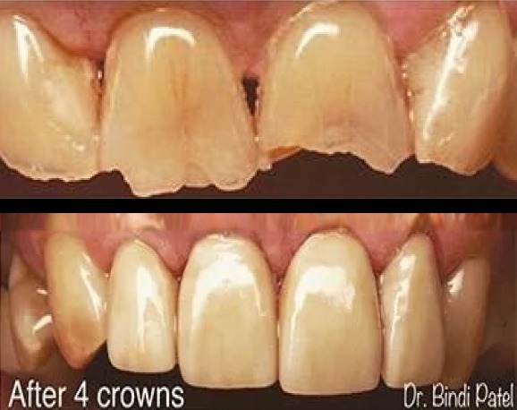 Dental crowns before and after results at Aurora, IL dental practice showing tooth restoration.