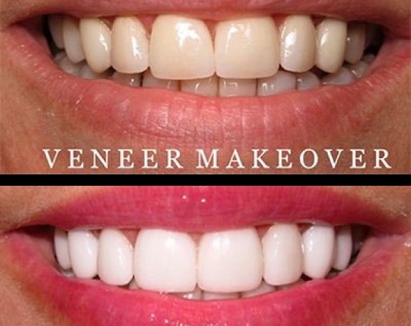 Dental veneers before and after results at Aurora, IL dental practice showing improved smile aesthetics.