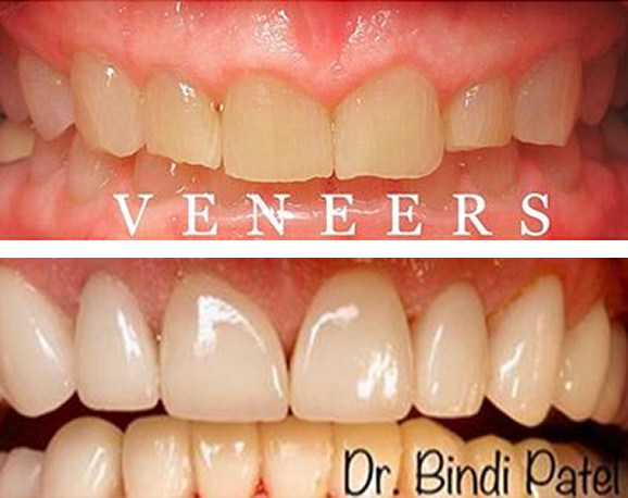 Dental veneers before and after results at Aurora, IL dental office showing improved tooth appearance.