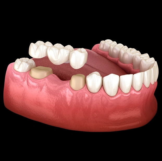 Dental bridge illustration showing missing tooth replacement at Aurora dental office in Illinois.