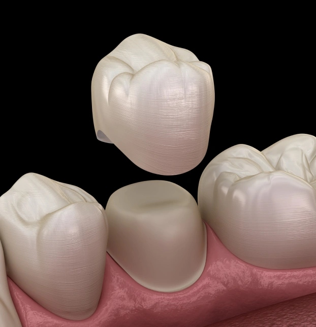 Dental crowns on upper and lower teeth at Aurora dental office in Illinois.