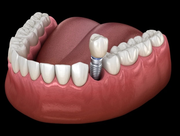 Dental implant illustration showing tooth replacement with implant crown and abutment in Aurora, IL.