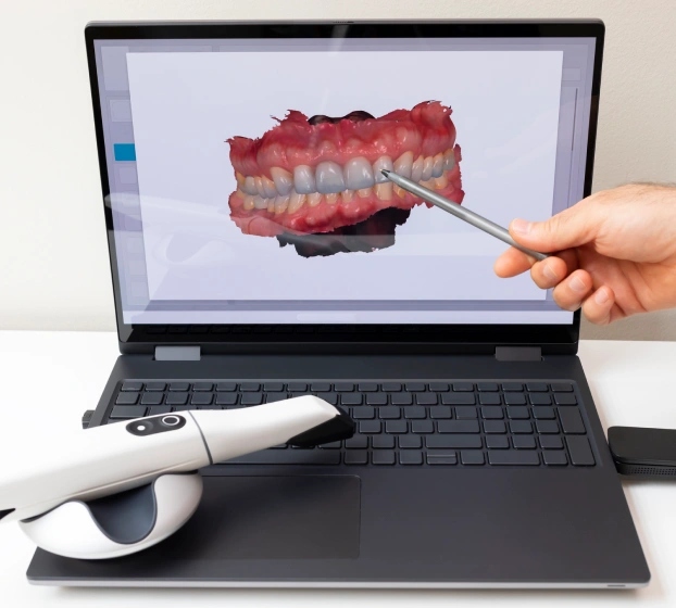 Intraoral scanner used for digital smile design at dental practice in Aurora, IL.