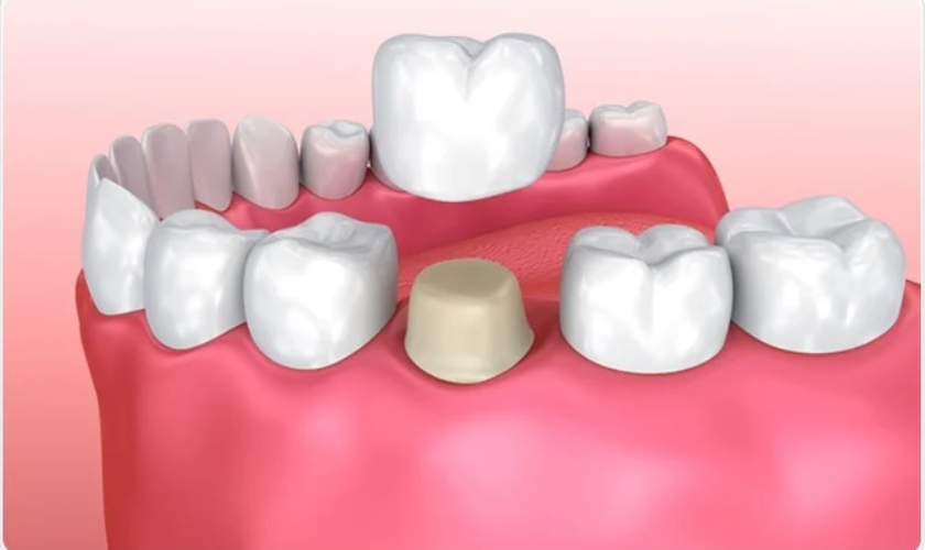 Explaining The Gap Behind Your Dental Crown And How To Fix It