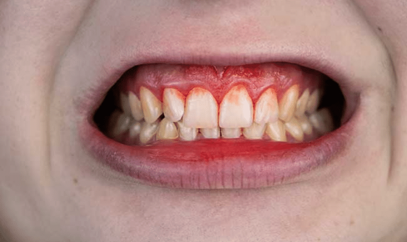 What Are The Different Antibiotics Used In Gum Disease