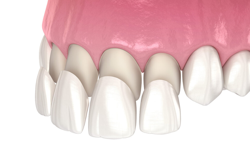 How Dental Veneers Can Transform Your Smile