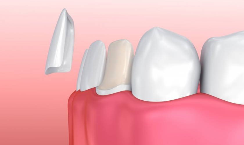 Know What You Should do If Your Veneer Falls off