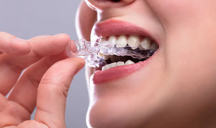 Night Guard Brands to Protect Your Teeth