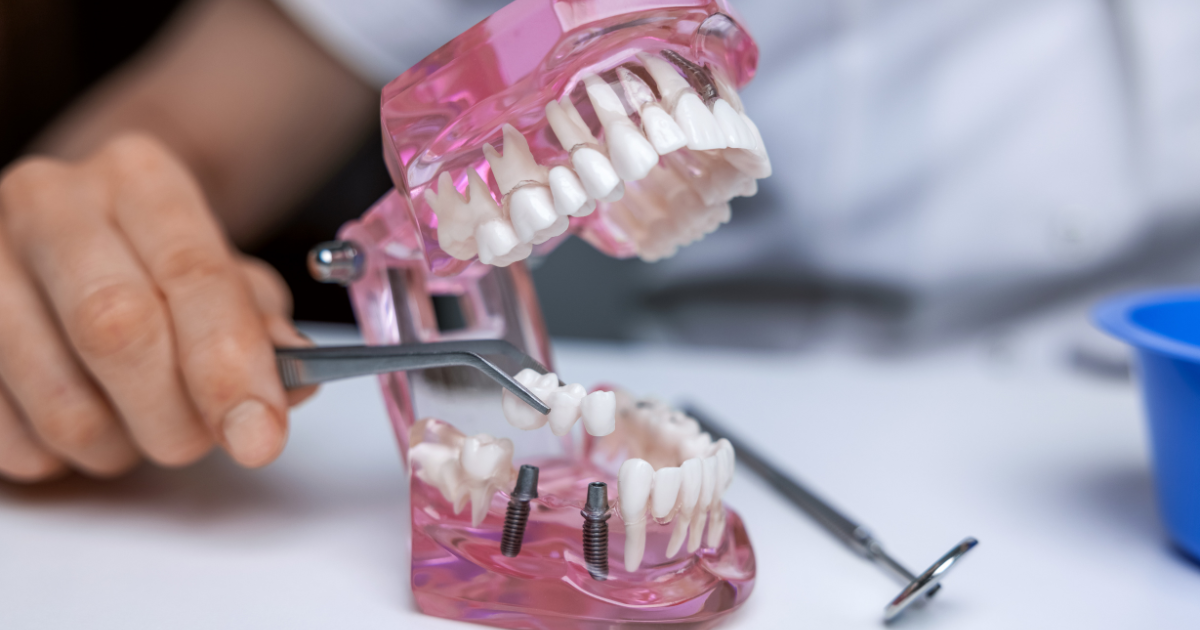 How to Care for Your Dental Bridge: Tips for Longevity and Comfort