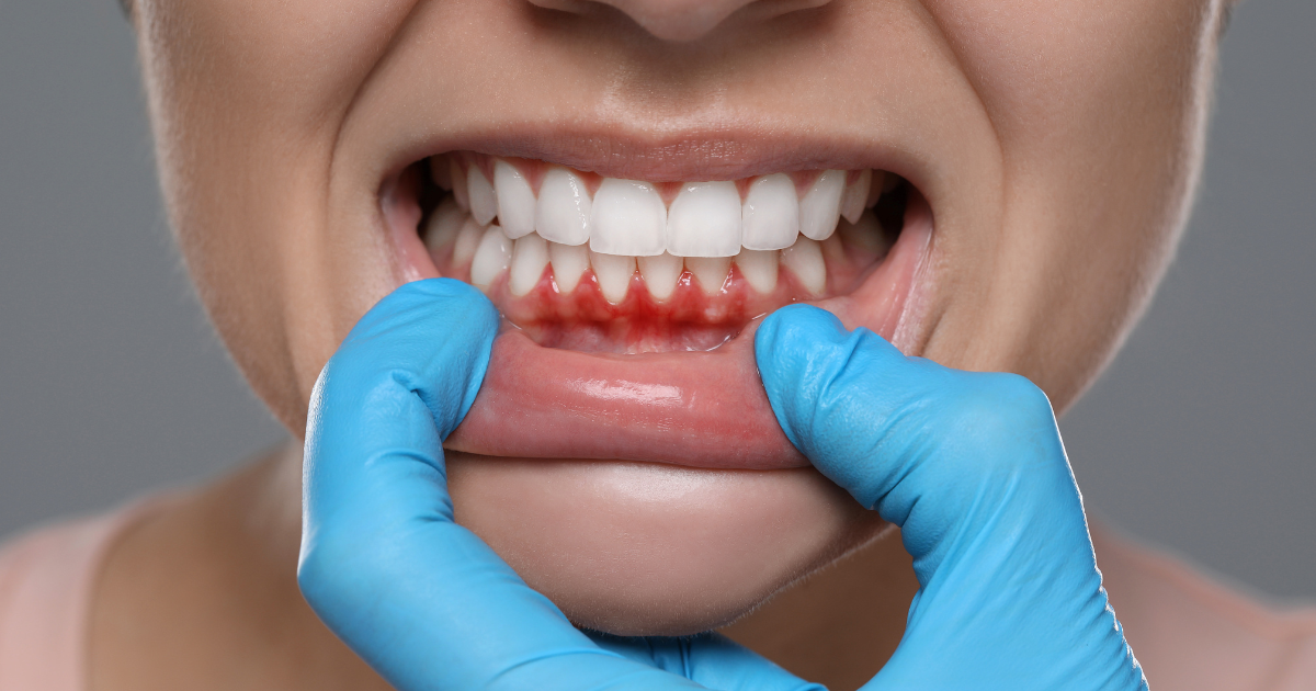 Understanding Gum Disease_ Symptoms, Stages, and Treatment Options