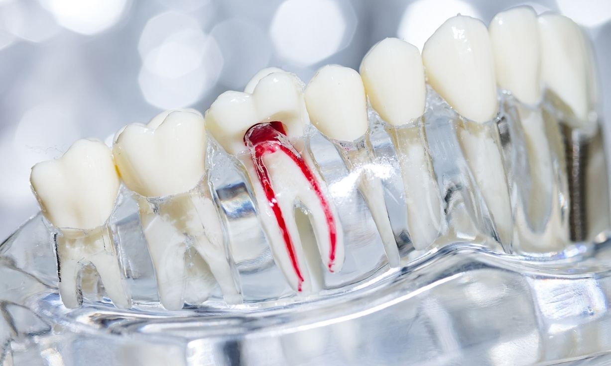 why root canals are essential for saving infected teeth