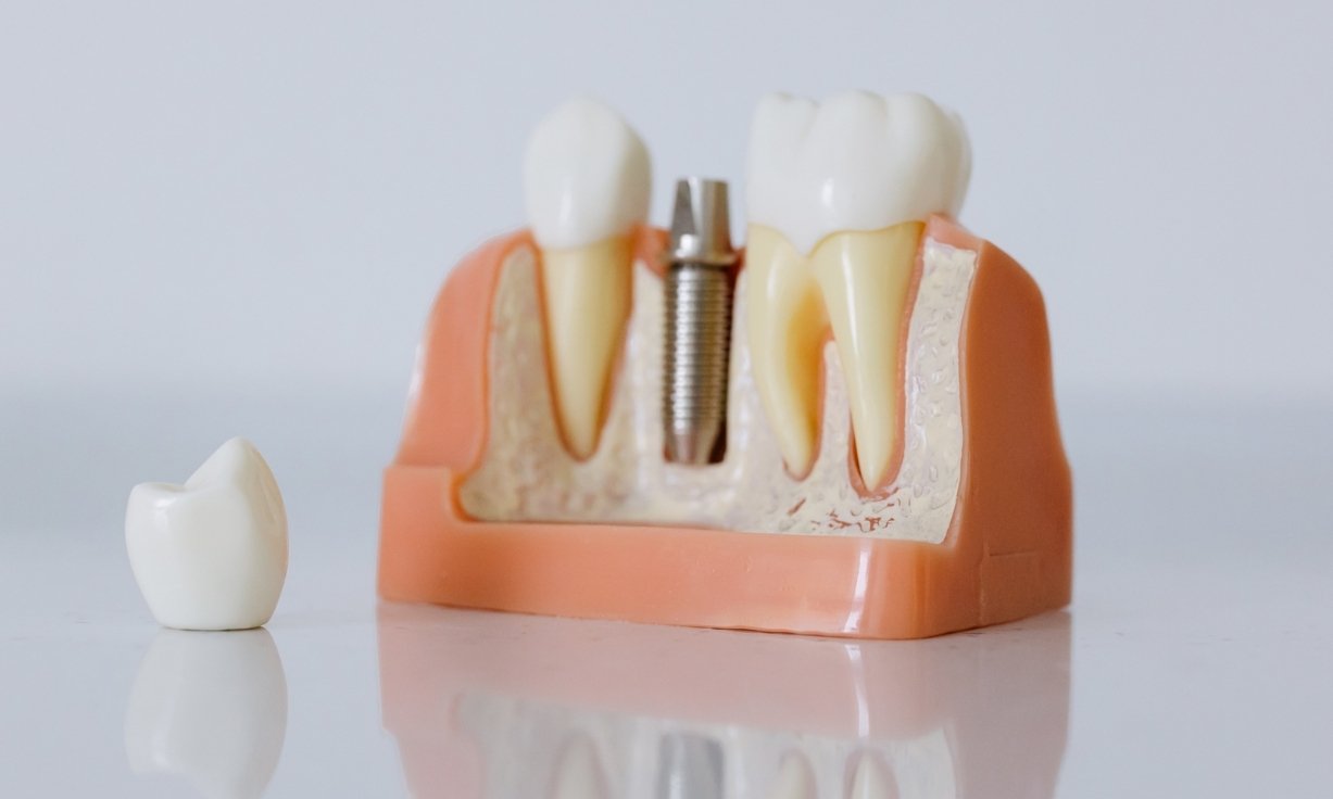 latest innovations in dental implants