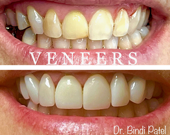 dental veneers before and after treatment