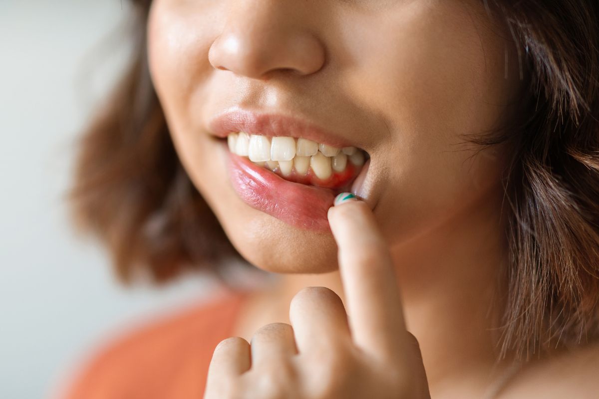 Sudden Gum Swelling